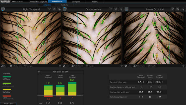 Canfield HairMetrix® konsultations software